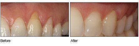receding gums treatment in East Hanover New Jersey