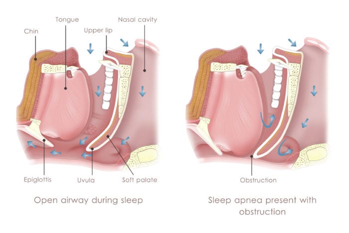 stop snoring sleep apnea florham park nj