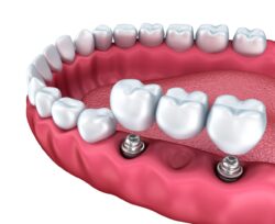 dental bridge for missing teeth in East Hanover, NJ