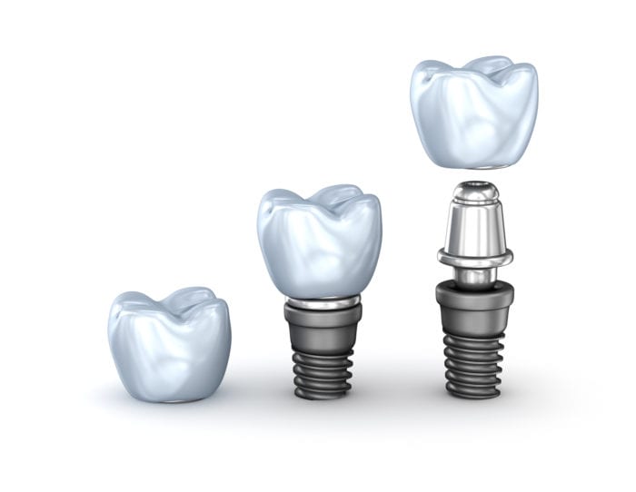 dental implants in East Hanover, NJ