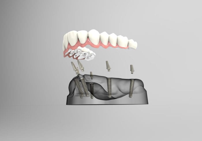 dentures secured with dental implants in East Hanover, NJ