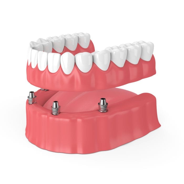 all on four dental implant secured denture in East Hanover, NJ