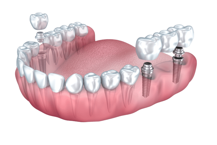 dental implant benefits in East Hanover, New Jersey