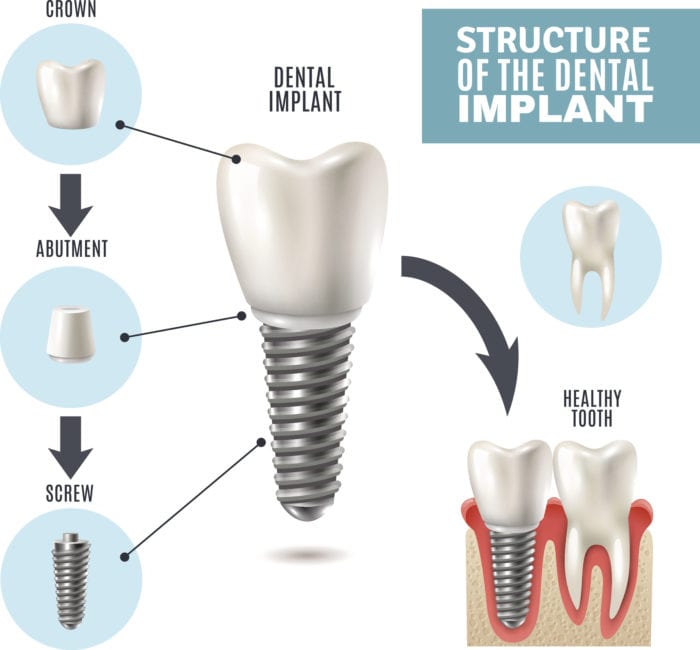 benefits of dental implants in East Hanover, NJ