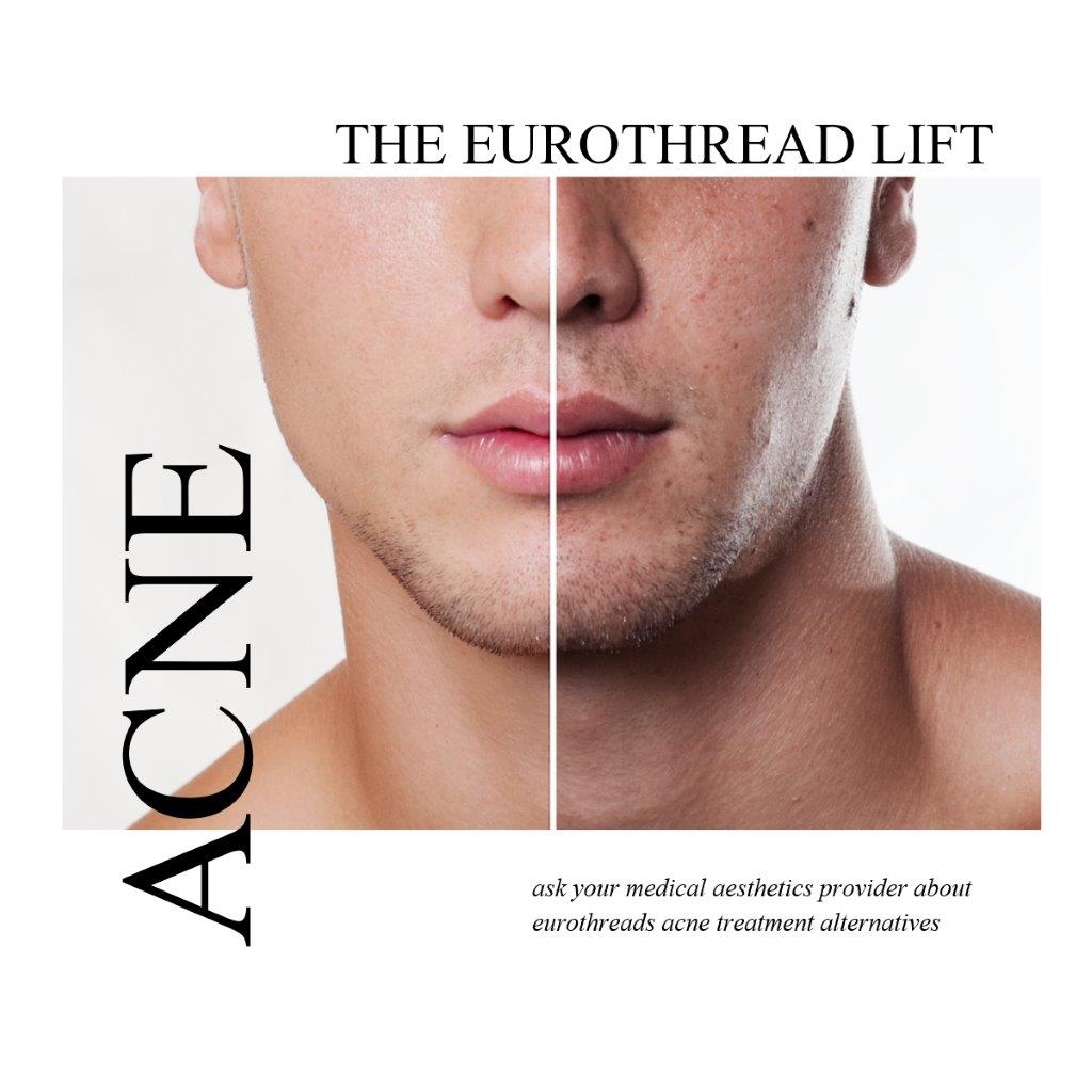 EuroThread Lift for acne problems