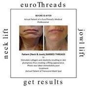 EuroThread Lift is a Non Surgical Facelift