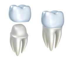 dental crowns in east hanover, nj