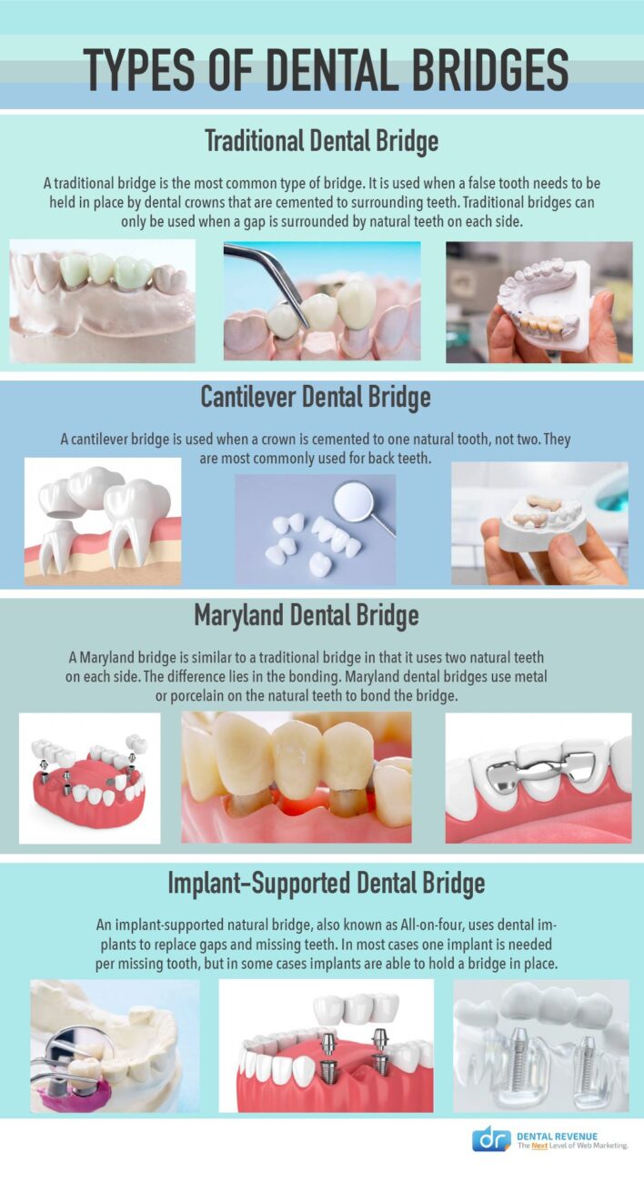 Types of Dental Bridges Infographic