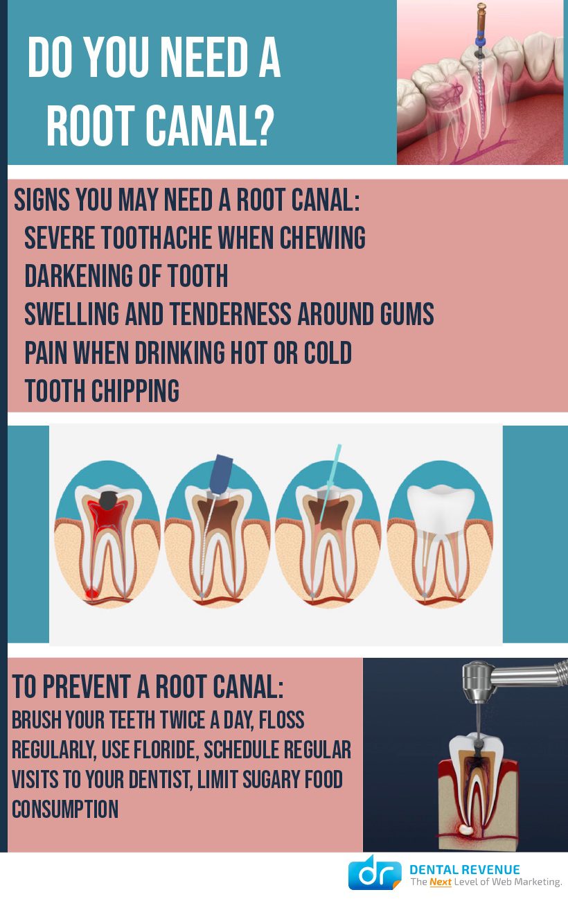 Do you need a root canal infographic