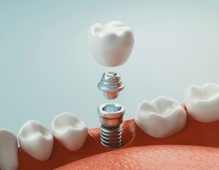 close up of dental implant pieces restorative dentistry dental implants dentist in Hanover New Jersey