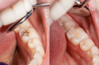 Side by side comparison of a tooth with a cavity and with a filling Dentist in East Hanover New Jersey