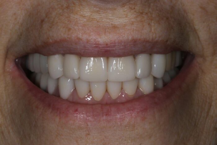 Client Focus-Smile Makeover