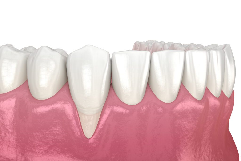 Receding Gums in Summit NJ