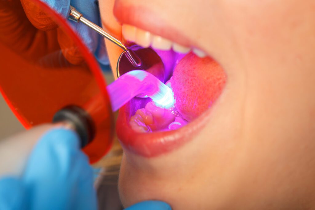 Teeth Bonding in Summit NJ
