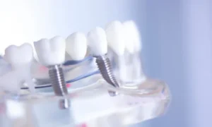 The Benefits of Dental Implants for Tooth Loss in East Hanover, NJ