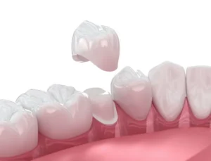 Same-Day Crowns vs. Traditional Crowns in East Hanover, NJ