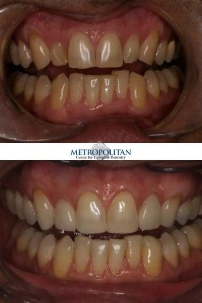 Before and After Whitening Summit NJ