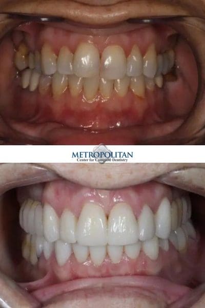 Before and After Cosmetic Dentistry in Summit NJ